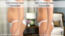 عمل جراحی زیبایی شکم پهلو Tummy Tuck عمل تامی تاک