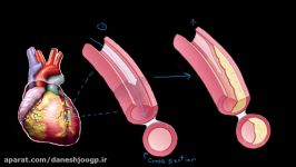 Atherosclerosis  Circulatory System and Disease  NCLEX RN  Khan Academy