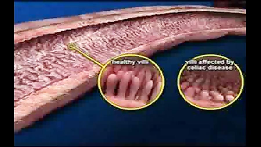 بیماران سلیاکی بدانند ؟
