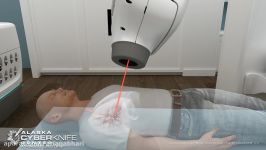 درمان سرطان ریه تکنولوژی CyberKnife