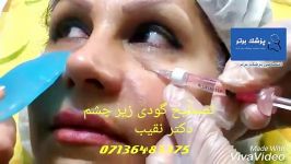 تزریق ژل هیالورونیک اسید جهت درمان گودی کبودی