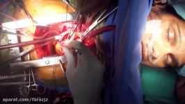 Awake Cardiac Surgery on a patient with Bombay Blood GroupFull HD