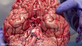 The Normal Unfixed Brain Neuroanatomy Video Lab  Brain Dissections