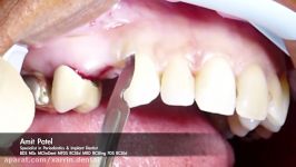 One stage surgery using Tapered Internal PLUS implant