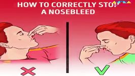 چگونه بطور صحیح خونریزی بینی را بند بیاوریم؟مهم