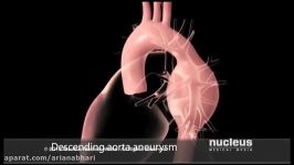 نارسایی دریچه آئورت قلب درمان، علائم علت  متخصص قلب