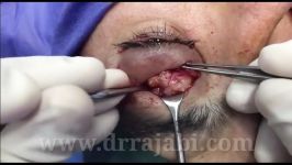 تومور سقف اربیت چشم orbital tumor