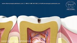 مقایسه آمالگام کامپوزیت