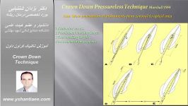 آموزش تکنیک کراون داون Crown Down Technique