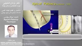 تکنیک آپیکال پیتنسی Apical patency Technique