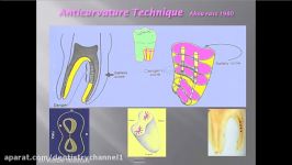 تکنیک anticurvature جهت جلوگیری استریپ پرفوریشن