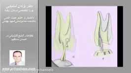 خطاهای شایع کلینیکی در اکسس مستقیم