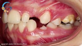 ارتودنسی کشیدن دندان  دکتر مسعود داوودیان