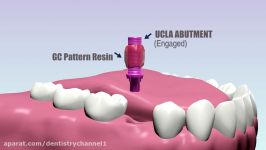 Single Unit UCLA Abutment Open Tray Impression Technique