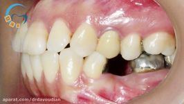 ارتودنسی همراه کشیدن دندان  دکتر مسعود داوودیان