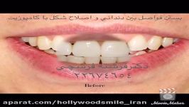 بستن فواصل بین دندانی اصلاح شكل دندان دکترفرشته فرشچی