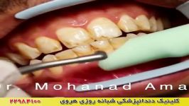 از بین بردن لکه های قهوه ای روی دندان ها