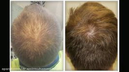 تقویت رشد مو سر به روش مزوتراپی PRP