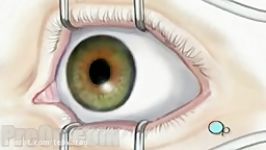 عمل جراحی چشم  تخت عمل جراحی چشم  صندلی جراحی چشم