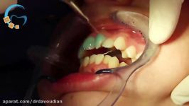 ارتودنسی بدون کشیدن دندان  دکتر مسعود داوودیان