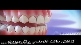 مراحل گذاشتن براکت ارتودنسی ثابت روی دندان