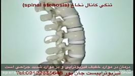 تنگی كانال نخاعspinal stenosis مشاورهtel09122655648