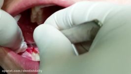 Surgical Ext of Lower Right Third Molar