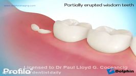 Removing Impacted Wisdom Teeth