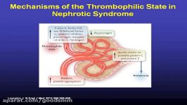 Nephrotic Syndrome with Dr. Caster