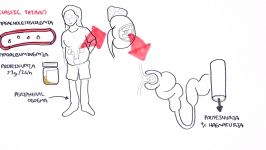 Nephrotic Syndrome  Types and pathology histology