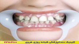 فیلم ارتودنسی دندان  ارتودنسی ثابت دندان