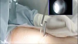 Transforaminal Endoscopic by Dr. Schubert