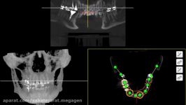 تهیه surgical guide سیستم R2GATE کمپانی مگاژن