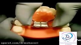 بازکننده فک expander