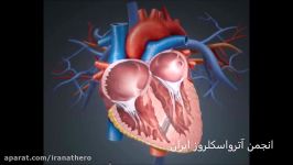 Trans catheter Trans septal Muscular VSD closure