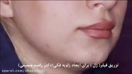 تزریق ژل برای ایجاد زاویه فكی