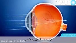 پیرچشمی چیست چگونه درمان می شود؟