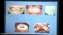 بررسی یک کیس ساده آگمنتاسیون در ناحیه زیباییدکتربهنیا