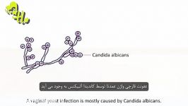 عفونت واژن زنانبیماری قارچی