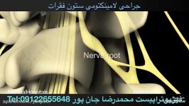 جراحی لامینکتومیانیمیشن پزشکی. فیزیوتراپی09122655648