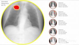 Meet the puter diagnosing cancer