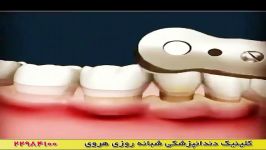 جلوگیری التهاب لثه جرمگیری دندان