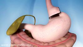 Gastric Bypass