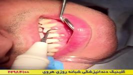 فیلم واقعی بلیچینگ جرمگیری دندان ها در دندانپزشکی