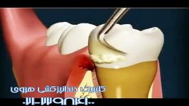 جرمگیری دندان مساوی سلامت لثه دندان