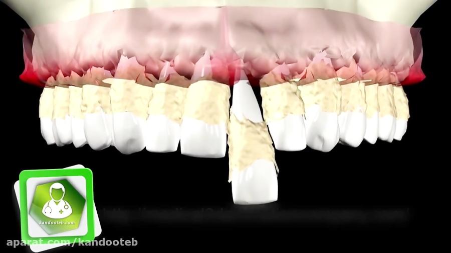 لق شدن دندان به دلیل تحلیل رفتن لثه جرم دندان