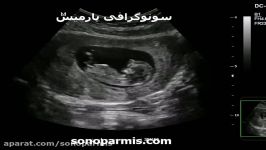 سونوگرافی غربالگری سه ماهه اول بارداری