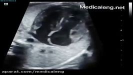 fetal echocardiography