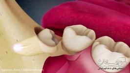 انیمیشن دندانپزشکی جراحی دندان عقل  دندانستان