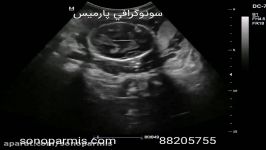 سونوگرافی غربالگری سه ماهه دوم بارداری
